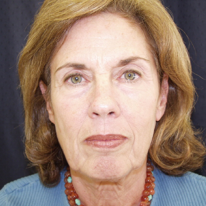 Deep Plane Facelift - Patient Before