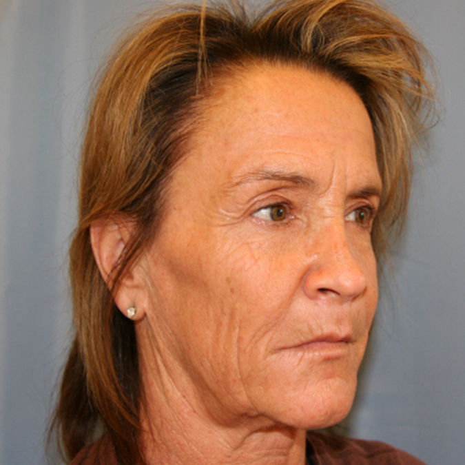 Facelift-Case--31 | Before Facelift