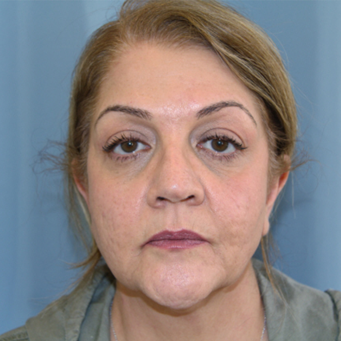Facelift-Case--33 | Before Facelift