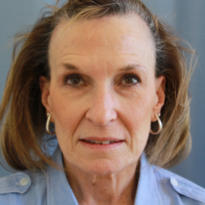 Facelift-Case--34 | Before Facelift