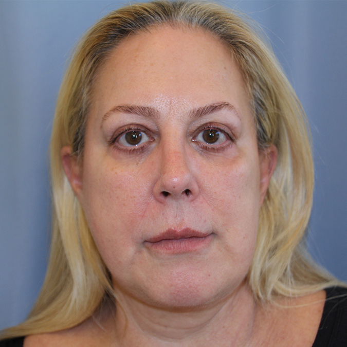 Facelift-Case--36 | Before Facelift