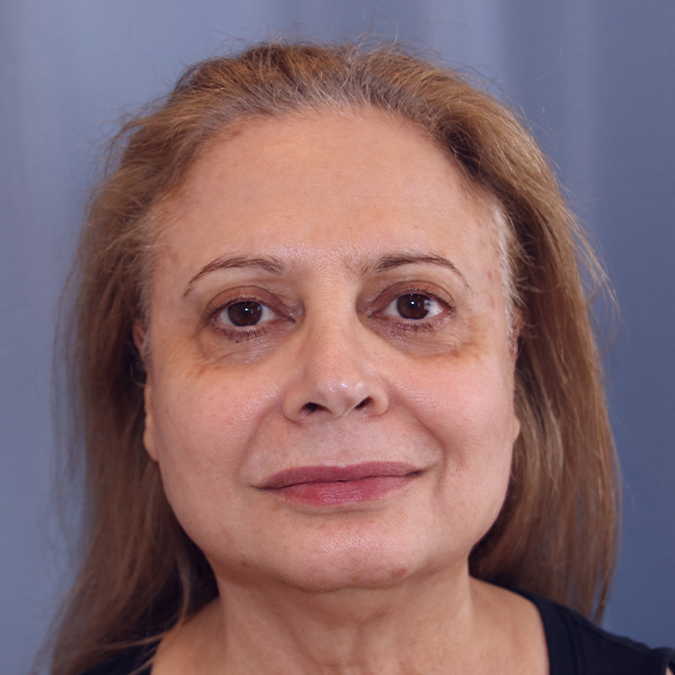 Facelift-Case--38 | Before Facelift