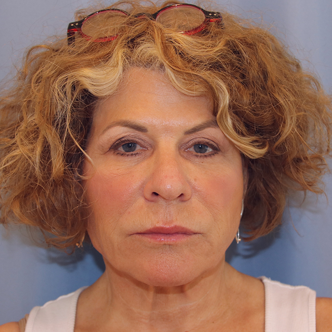 Facelift-Case--39 | Before Facelift