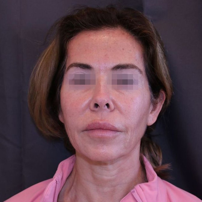 Facelift-Case--41 | Before Facelift