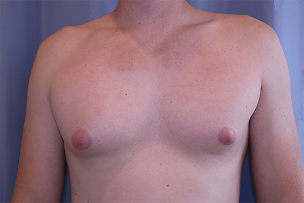 Gynecomastia-Case--01 | Before Gynecomastia