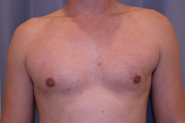 Gynecomastia-Case--01 | After Gynecomastia