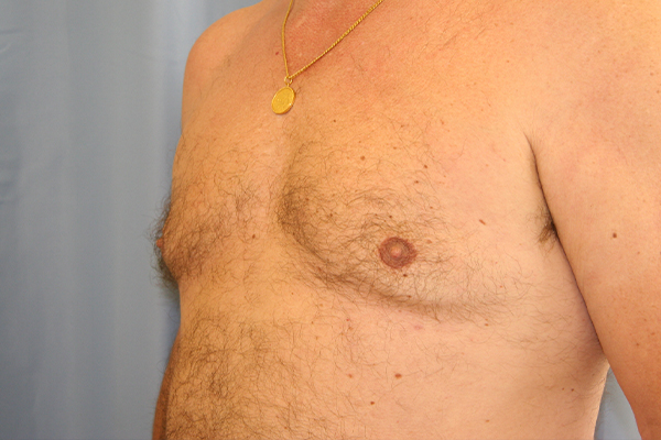 Gynecomastia-Case--02 | After Gynecomastia
