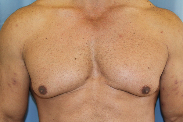 Gynecomastia-Case--03 | Before Gynecomastia