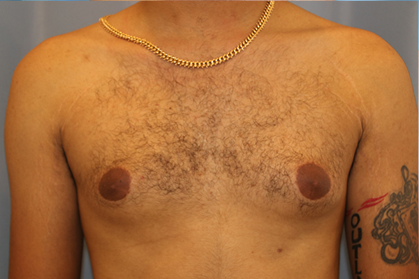 Gynecomastia-Case--04 | Before Gynecomastia