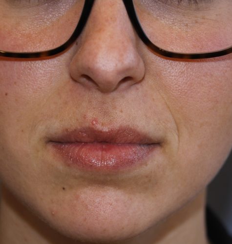 Juv--derm--x2122--Case--01 | Before Juvéderm™