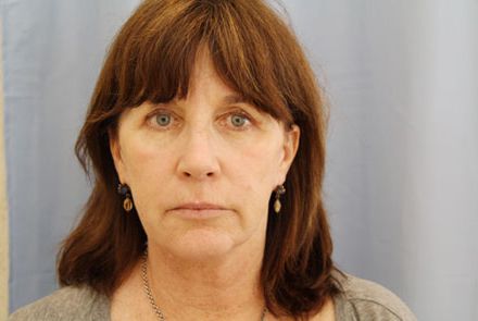Laser Resurfacing - Patient After