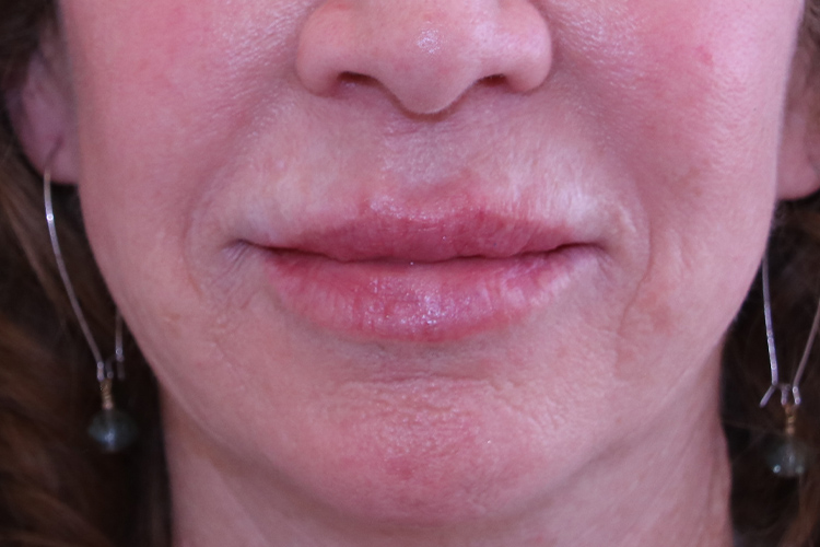 Lip Lift - Patient Before