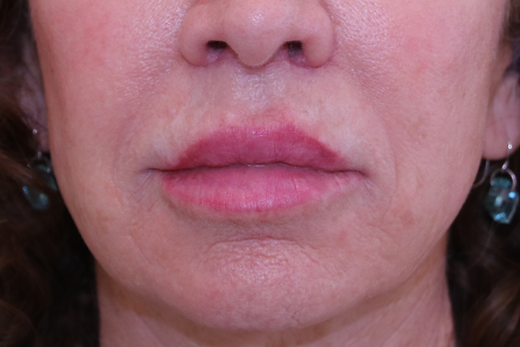 Lip Lift - Patient After