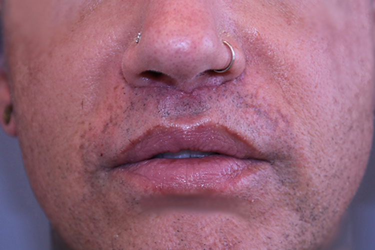 Lip-Lift-Case--13 | After Lip Lift