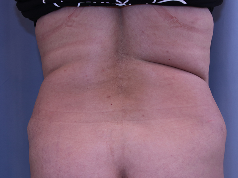 Liposuction-Case--02 | Before Liposuction