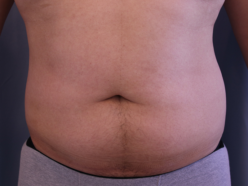 Liposuction-Case--03 | Before Liposuction