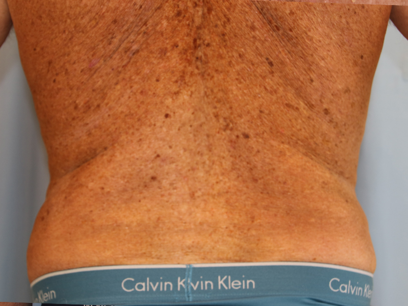 Liposuction-Case--04 | After Liposuction