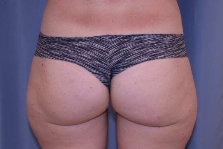 Liposuction-Case--07 | Before Liposuction