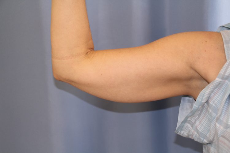 Liposuction-Case--09 | Before Liposuction