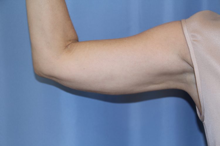 Liposuction-Case--09 | After Liposuction