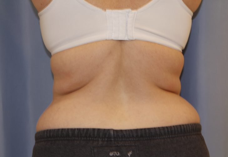 Liposuction-Case--10 | Before Liposuction