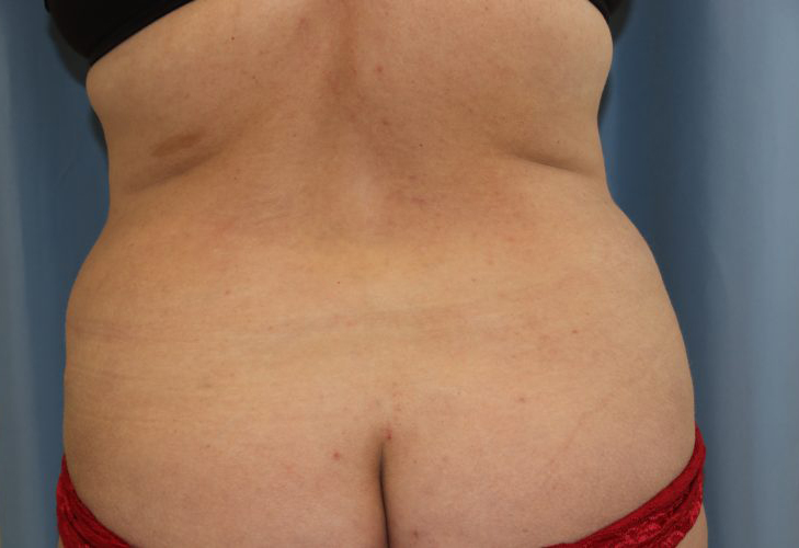 Liposuction-Case--10 | After Liposuction
