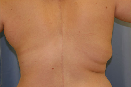 Liposuction-Case--13 | Before Liposuction