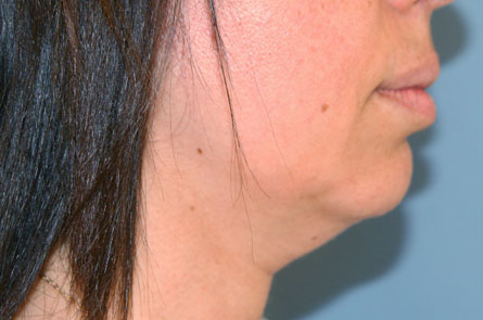 Liposuction-Case--15 | Before Liposuction