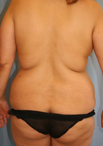Liposuction-Case--16 | Before Liposuction