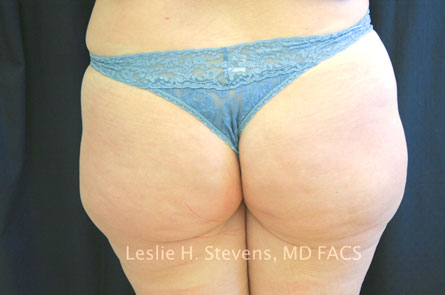 Case--3901 | Before Liposuction