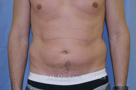 Liposuction-Case--20 | Before Liposuction