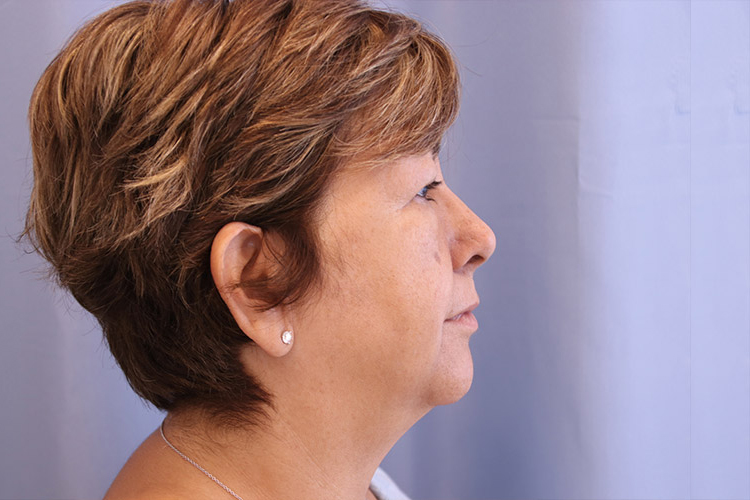 Liposuction-Case--21 | Before Liposuction