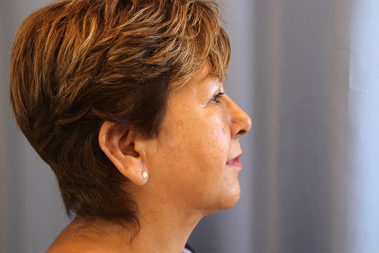 Liposuction-Case--21 | After Liposuction