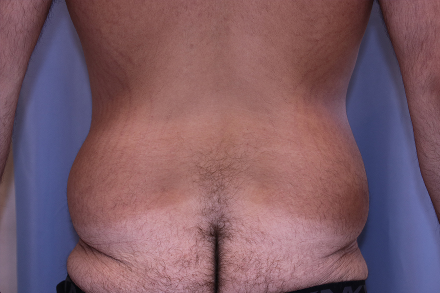 Liposuction-Case--23 | Before Liposuction