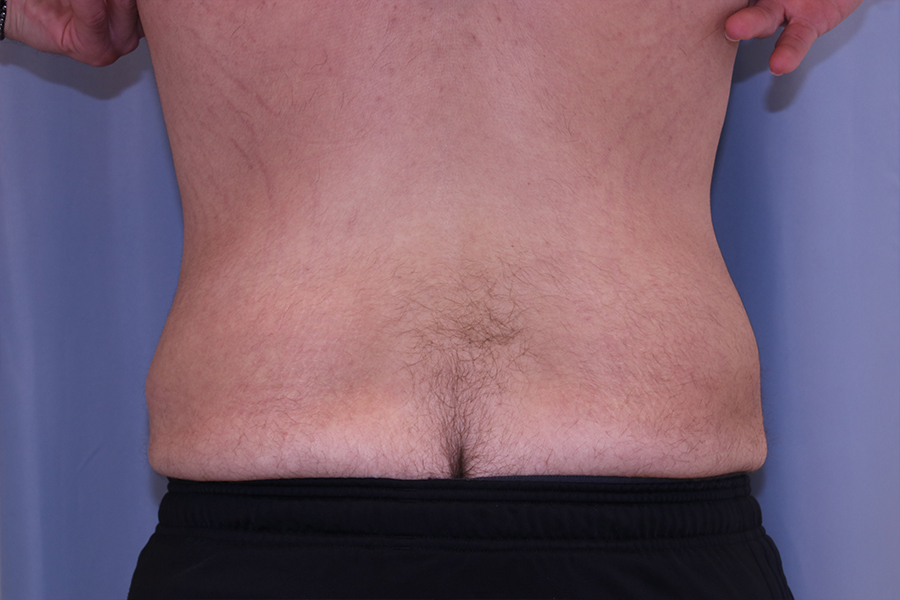 Liposuction-Case--23 | After Liposuction