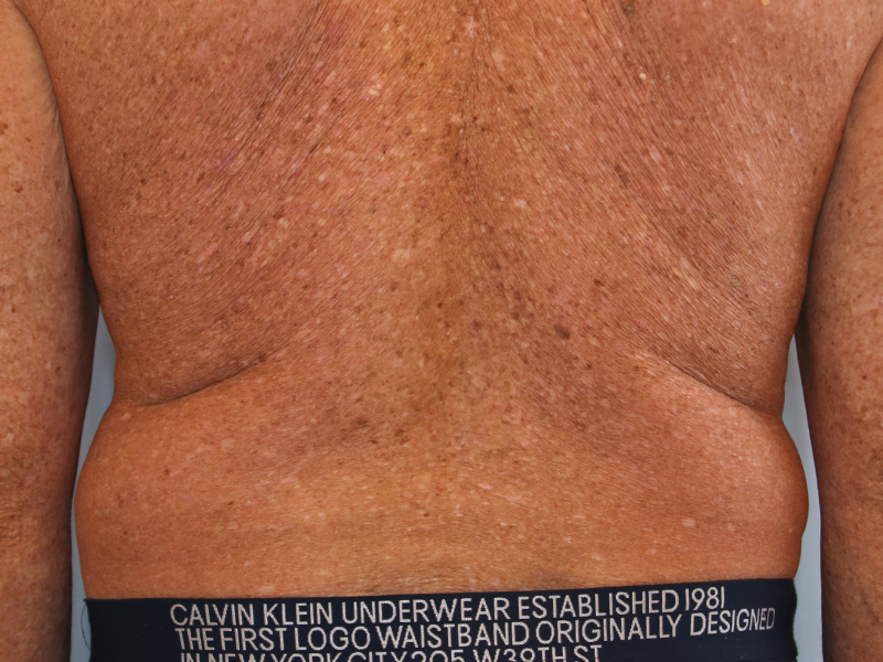 Liposuction-for-Men-Case--02 | Before Liposuction for Men