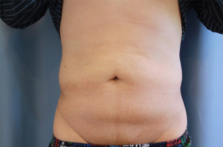 Case--2815 | Before Liposuction for Men