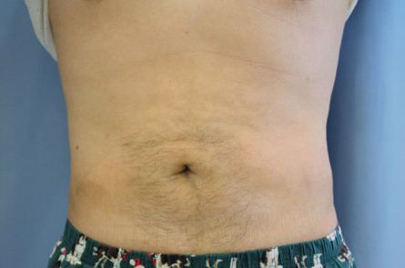 Case--2815 | After Liposuction for Men