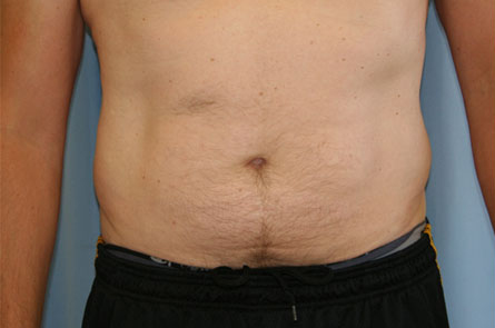 Liposuction-for-Men-Case--04 | Before Liposuction for Men