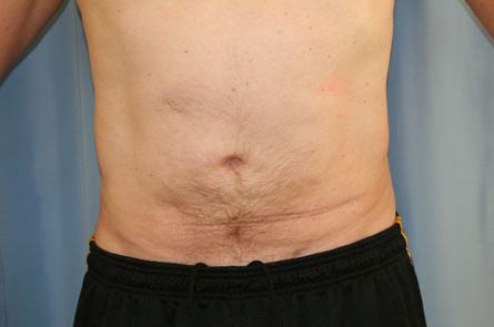 Liposuction-for-Men-Case--04 | After Liposuction for Men