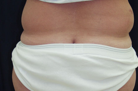 Liposuction-for-Men-Case--05 | Before Liposuction for Men