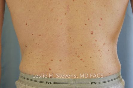 Liposuction-for-Men-Case--06 | After Liposuction for Men