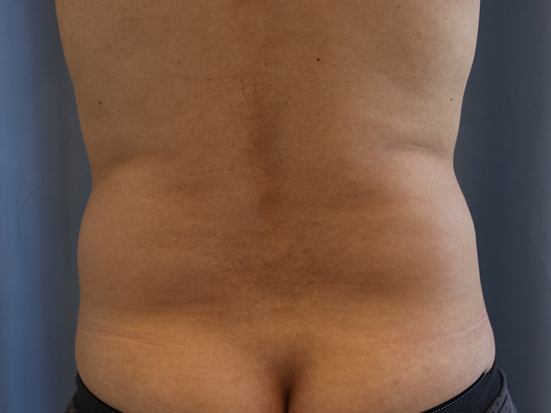 Liposuction-for-Men-Case--08 | Before Liposuction for Men
