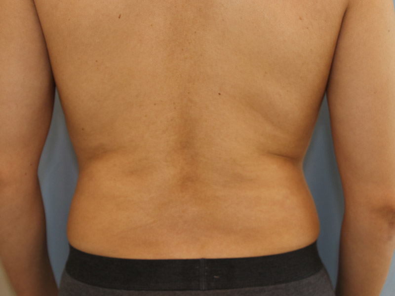 Liposuction-for-Men-Case--08 | After Liposuction for Men