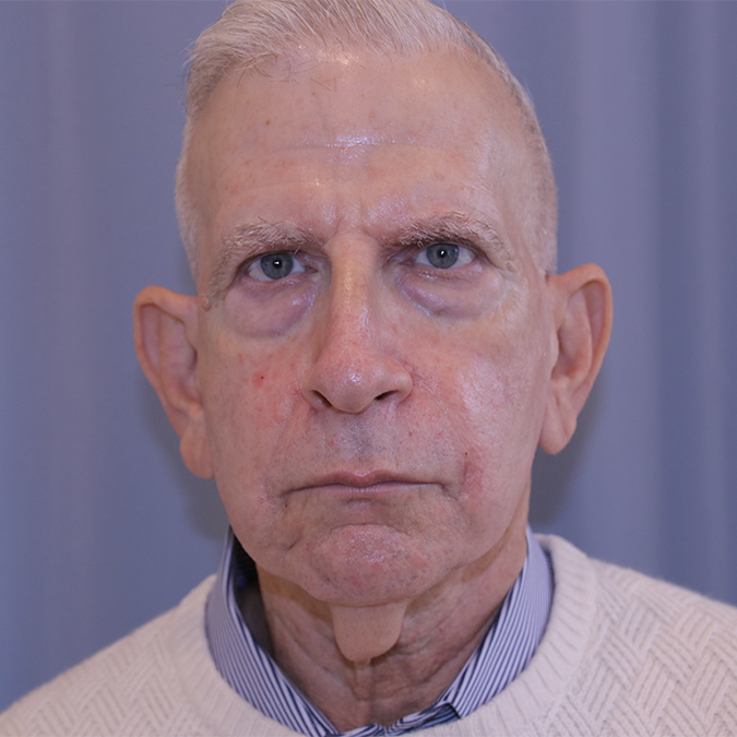 Neck-Lift-Case--04 | Before Neck Lift