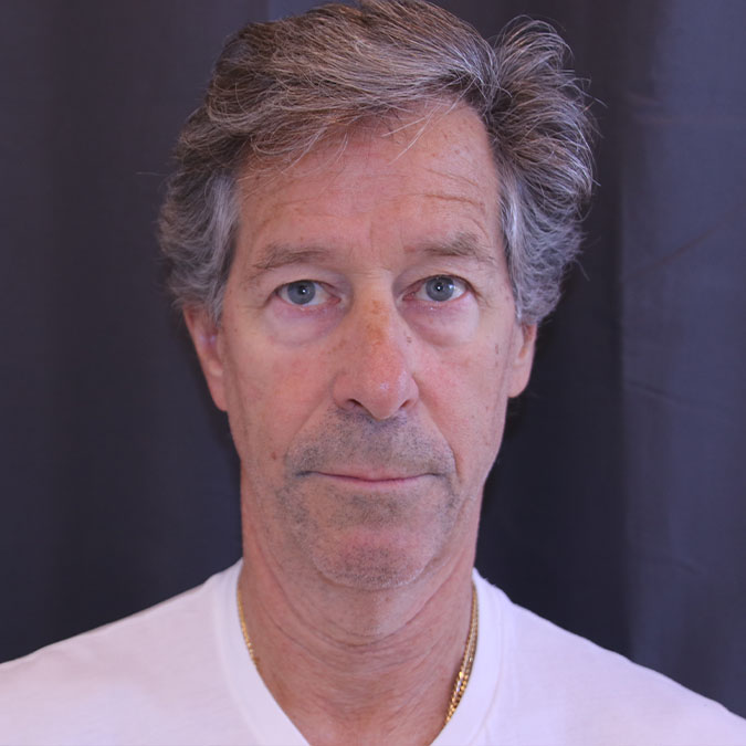 Neck-Lift-for-Men-Case--02 | Before Neck Lift for Men