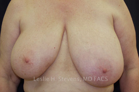 Breast-Reduction-Case--10 | Before Breast Reduction