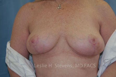 Breast-Reduction-Case--08 | After Breast Reduction