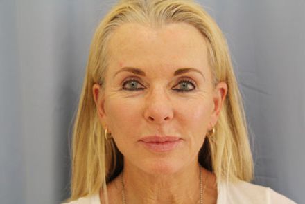 Neck-Lift-Case--02 | After Neck Lift