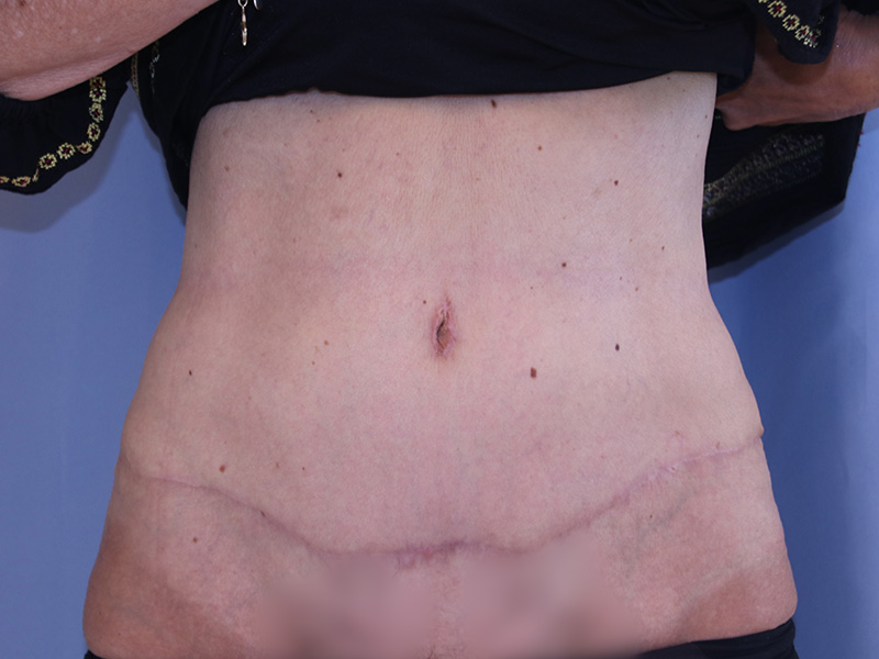 Tummy-Tuck-Case--04 | After Tummy Tuck